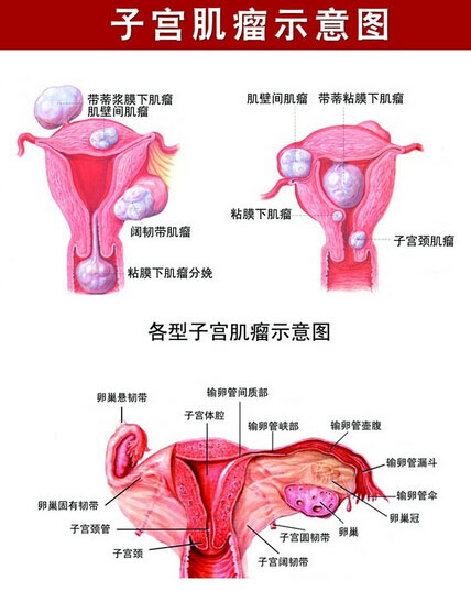 月经不调小心是子宫肌瘤惹的祸