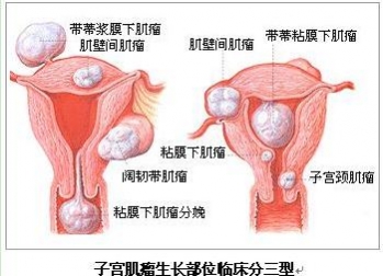 子宫肌瘤的隐在妇科症状--女性经期过长