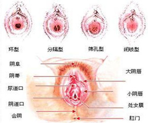 处女膜闭锁图解