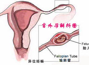 西宝专家简述：宫外孕复发的原因