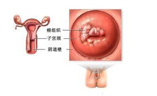 宫颈炎生理解剖图