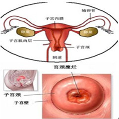 宫颈炎会引起外阴瘙痒吗