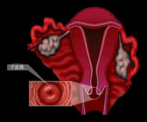 宫颈形态异常造成的女性宫颈性不孕