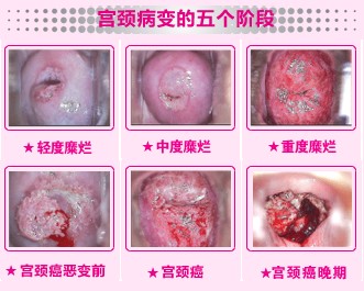 如何治疗宫颈糜烂?杨陵哪家医院治疗宫颈糜烂比较好?