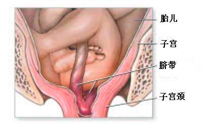 什么叫脐带脱垂?杨陵妈妈如何预防脐带脱垂?