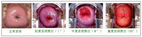 二度宫颈糜烂的治疗