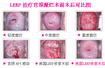 宫颈糜烂的症状