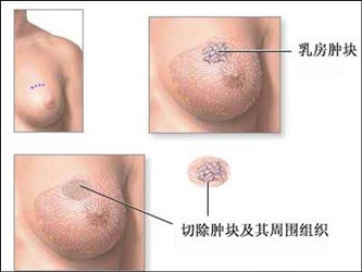 乳腺囊肿怎么治疗