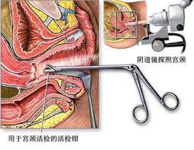 女性毛滴虫病主要症状是什么?