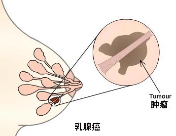 专家教你识别乳腺癌