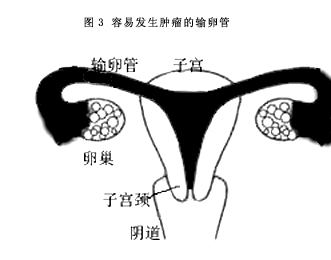 怎么判断是否患了卵巢囊肿