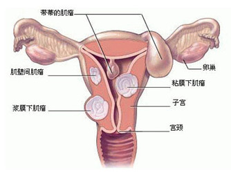 杨陵哪家医院治疗子宫肌瘤好?